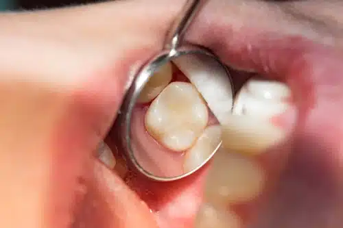 White-Fillings