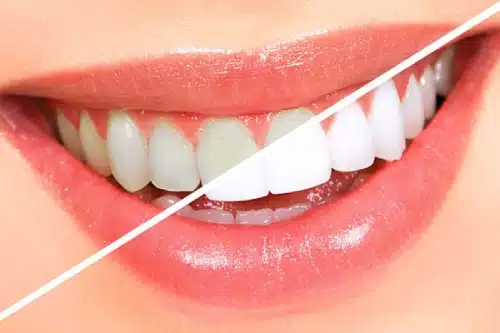 teeth-whitening